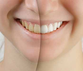 Cosmetic Dentist Provides Tips For Keeping Your Smile White