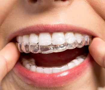 Dr. Sabharwal and the team at Sabharwal Dental Group offer invisible braces to straighten teeth