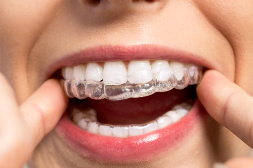 Dr Sabharwal Orthodontic Treatment